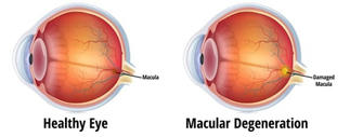 Macular Disease and Nutrition: Can Diet Help Protect Your Vision?